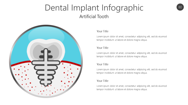 Dental Implant Infographic